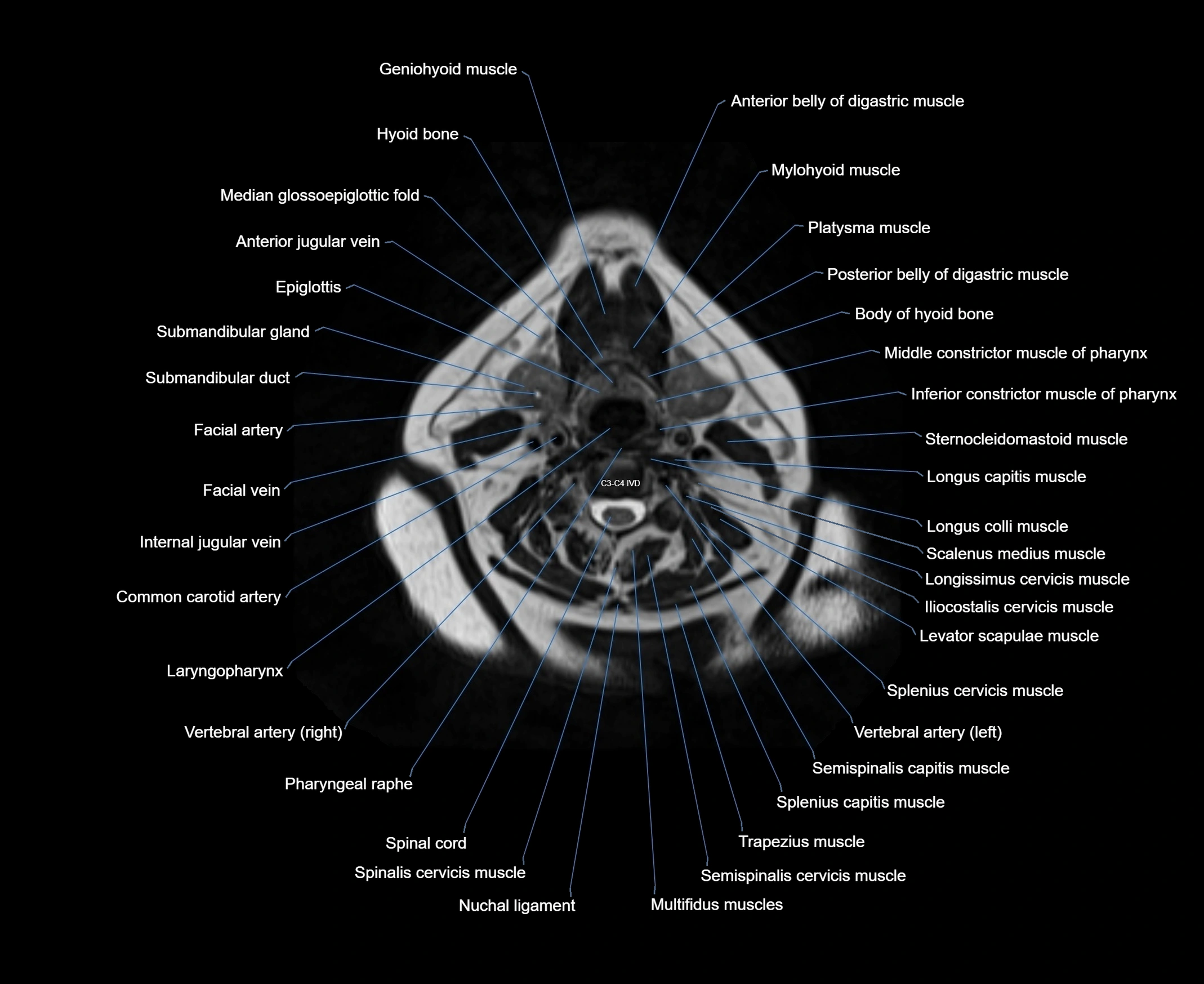 MRI Neck 3D labelled cross section anatomy axial 3t image-00001-00049.webp